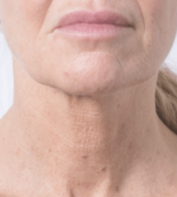 profhilo-肌底細胞活化-after2